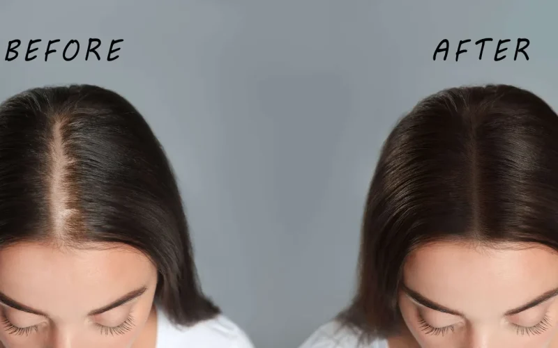 Hair_Mesotherapy_Header_FINAL-scaled-2