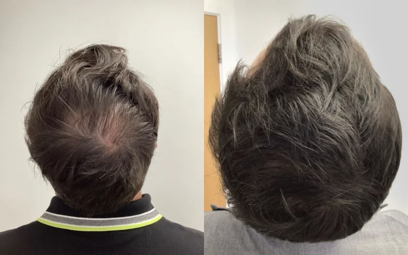 Non-Surgical-Hair-Treatment-Before-And-After